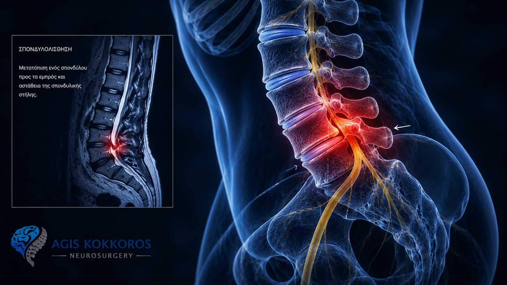 Lumbar-spine-spondylolisthesis-infographic