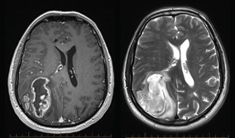 Γλοίμωμα υψηλής κακοήθειας - glioblastoma